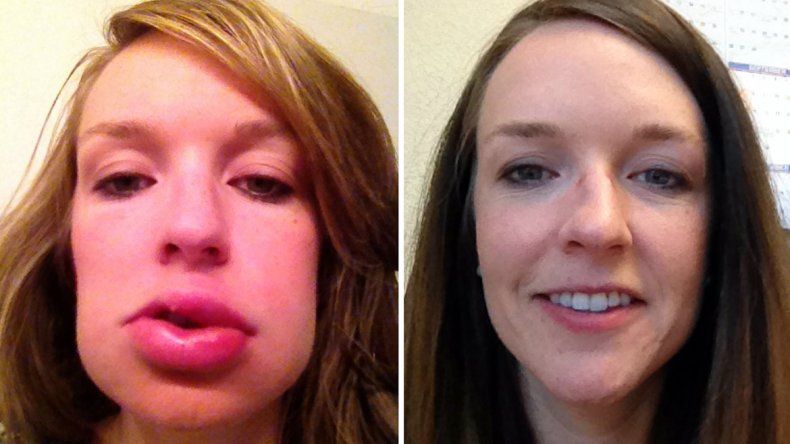 que es un angioedema hereditario que es un angioedema hereditario
