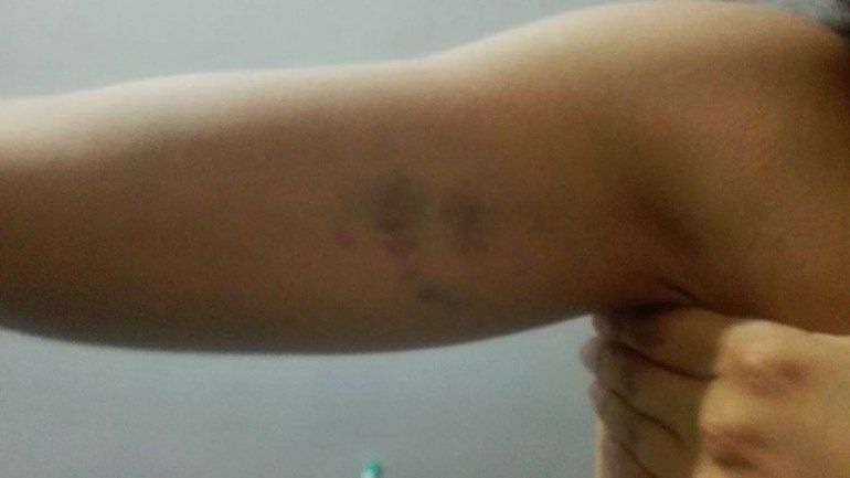 La joven quedó con un hematoma en uno de sus brazos.