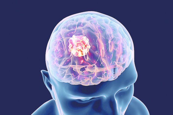 La ciencia por ahora desconoce las causas de este tipo de cáncer.