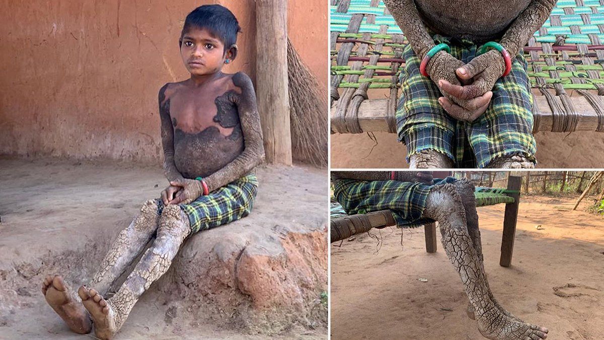 La pesadilla del niño que tiene la piel como piedra | enfermedad, India