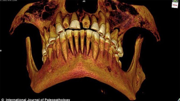En 2012 se dio con la primera momia con empastes dentales. Tenía una antigüedad de más de 2000 años.