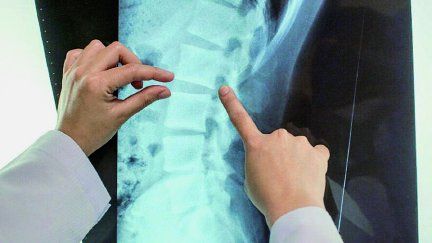 La vacuna de AstraZeneca y la Universidad de Oxford provocó un síndrome inflamatorio espinal poco común llamado mielitis transversa.