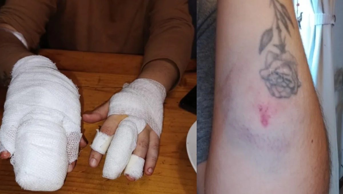 La familia de la víctima denunció la agresión por redes sociales y compartió imágenes de las heridas que sufrió en sus manos, antebrazos, rostro y pecho.&nbsp;