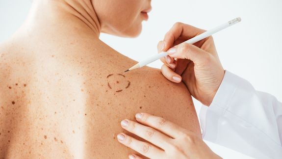 Día Mundial del Cáncer de Piel: cómo prevenirlo