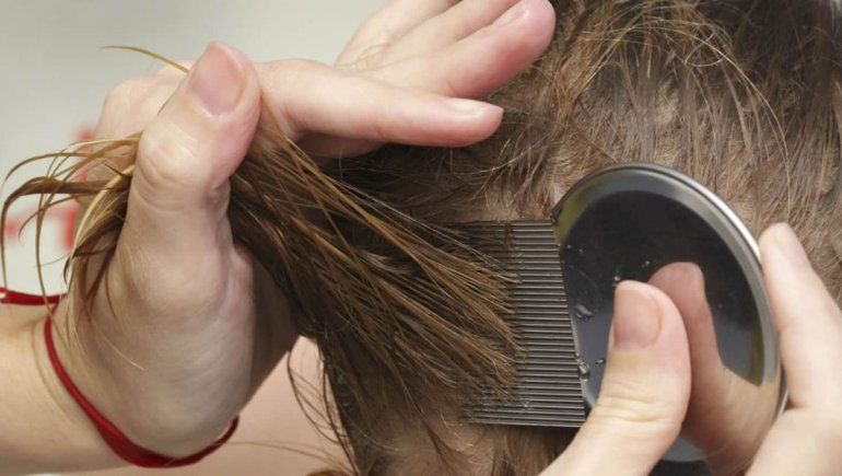 Los piojos son cada vez más resistentes