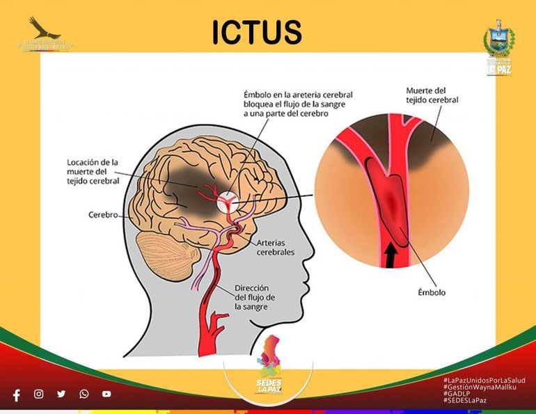 El papa Francisco murió por una apoplejía cerebral (ictus) y un colapso cardiovascular irreversible en el contexto de un coma profundo. El papa Francisco murió por una apoplejía cerebral (ictus) y un colapso cardiovascular irreversible en el contexto de un coma profundo.