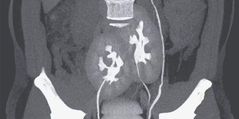 Tras una tomografía, médicos descubrieron que el paciente tenía tres riñones. Tras una tomografía, médicos descubrieron que el paciente tenía tres riñones.