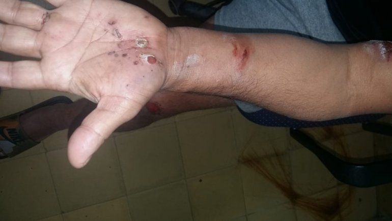 El hombre resultó herido tras el ataque de las pitbulls en Aluminé.