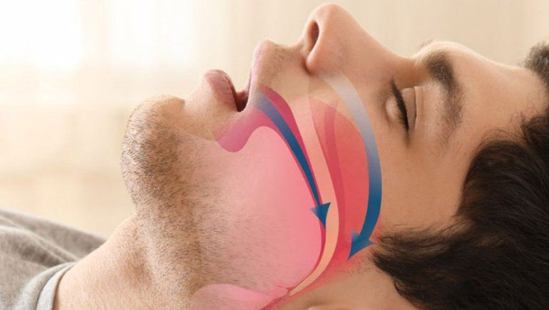 Apnea: hay más riesgos de eventos cardiovasculares