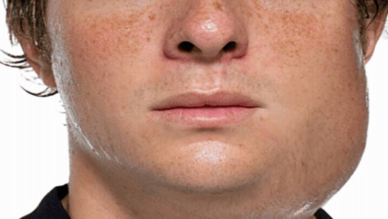 Los casos de paperas aumentaron un 200 % en el último año.&nbsp;