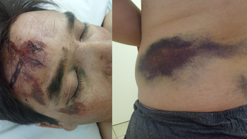 Sebastián es uno de los petroleros que fueron chocados en Ruta 51 y terminó internado en terapia intensiva durante seis días. Sebastián es uno de los petroleros que fueron chocados en Ruta 51 y terminó internado en terapia intensiva durante seis días.