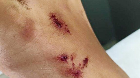 Una nena fue mordida por una yarará cuando tomaba sol