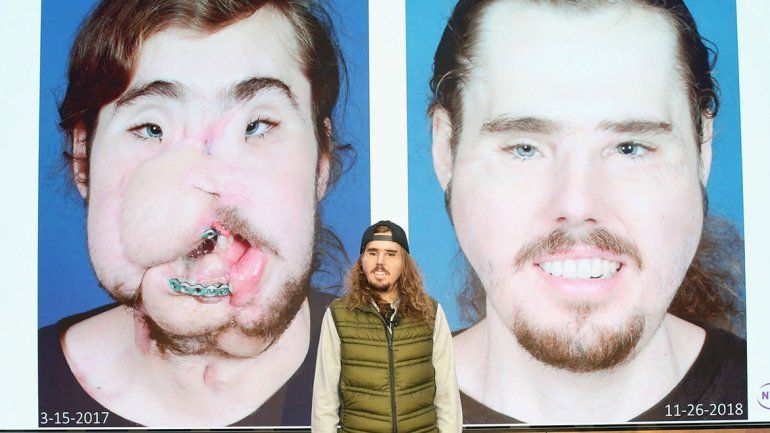 Un trasplante de cara le salvó la vida a un joven