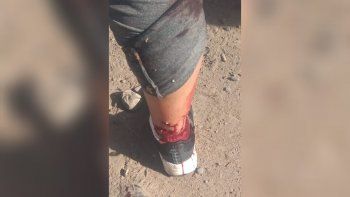 terrible: un perro ataco a una mujer y su dueno efectuo varios disparos terrible: un perro ataco a una mujer y su dueno efectuo varios disparos