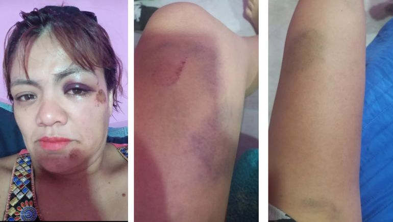 Una jauría atacó a una ciclista en Villa La Angostura