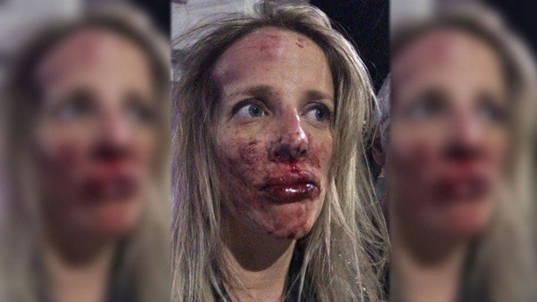 Desfiguran a cirujana al salir de una fiesta