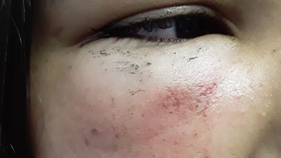 Una menor fue brutalmente golpeada en el colectivo - Parte de las heridas que recibió.&nbsp;