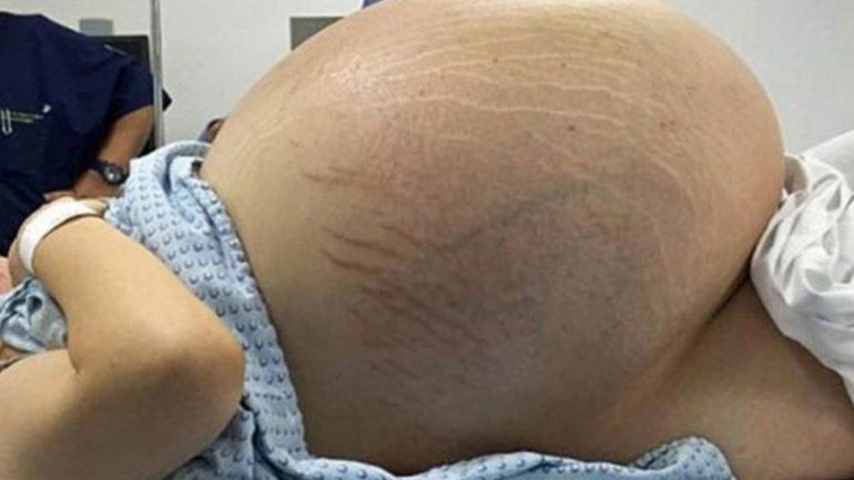 La mexicana estaba preocupada porque hacía ejercicios y no podía bajar de peso. Su tumor es récord mundial.