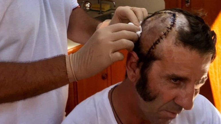 Un toro le arrancó parte del cuero cabelludo a un torero