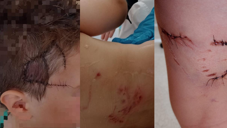San Martín de los Andes: un padre desesperado reclama que sacrifiquen a la perra que atacó a su hijo