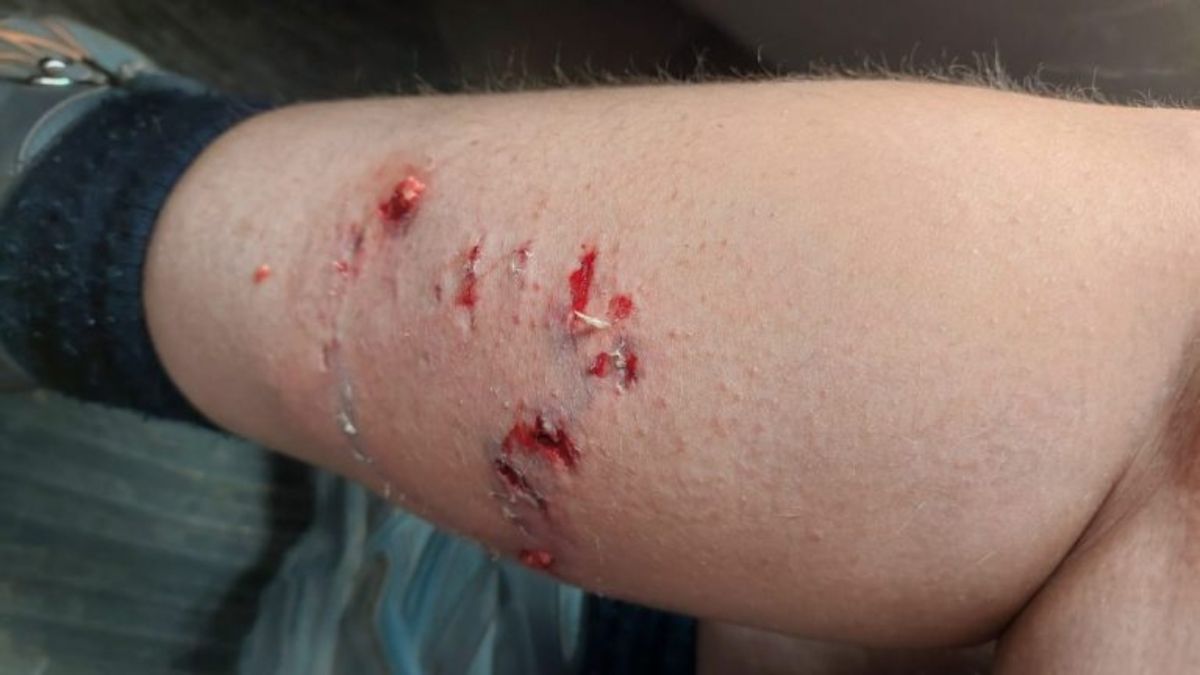 Una turista andaba en bicicleta y fue atacada por perros en La Angostura thumbnail