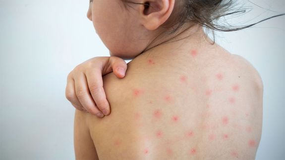 Las provincias argentinas resolvieron reforzar la vacunación para prevenir el Sarampión.&nbsp;