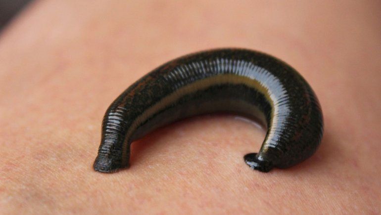 Lo llevan al doctor por una tos y tenía una sanguijuela viva