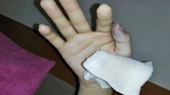 fue por un cuadro gripal y casi pierde un dedo