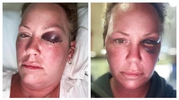 De vuelta en Ontario, donde reside, la turista canadiense habló con un medio local. Todavía tenía secuelas en su ojo producto del puñetazo. De vuelta en Ontario, donde reside, la turista canadiense habló con un medio local. Todavía tenía secuelas en su ojo producto del puñetazo.