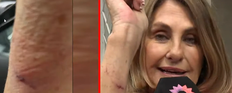 La periodista mostró en cámara las heridas que sufrió tras el robo.