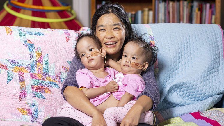 Siamesas unidas por abdomen y tórax al quirófano