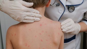 Viruela del mono: cómo se contagia y síntomas Viruela del mono: cómo se contagia y síntomas