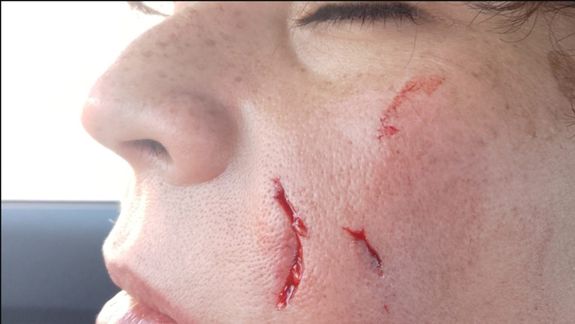 Luego del ataque, la víctima mostró las heridas que sufrió: el perro se escapó de un patio por un alambrado roto y fue directo hacia ella.&nbsp;