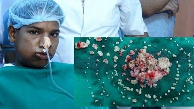 Ashik Gavai y sus extracciones.