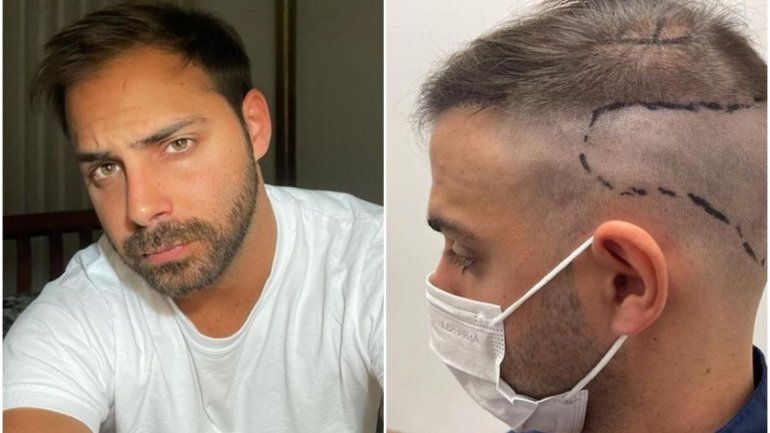 Las redes, revolucionadas por el implante capilar de Grego Rossello