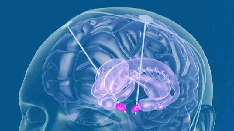 Un marcapasos cerebral para no perder momentos