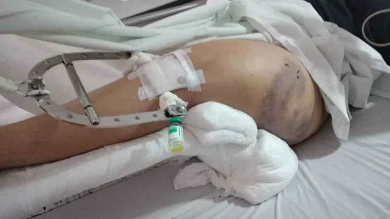 La pierna de la taxista que sufrió el accidente. Gentileza La pierna de la taxista que sufrió el accidente. Gentileza