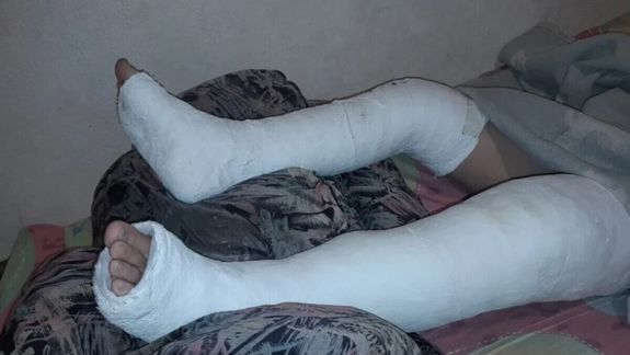 Comodoro Rivadavia: lo atropellaron y deben ponerle cuatro clavos en las piernas.