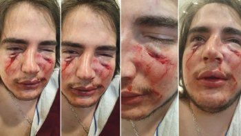El joven agredido salvajemente por los rugbiers en Córdoba. El joven agredido salvajemente por los rugbiers en Córdoba.
