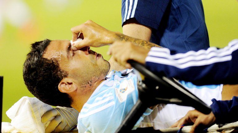 El Apache recibió un codazo en la nariz jugando para la Selección.