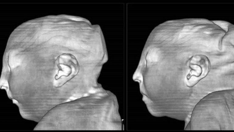 En Tucumán hay un brote de esta enfermedad que provocó 24 casos.