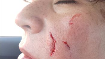 Luego del ataque, la víctima mostró las heridas que sufrió: el perro se escapó de un patio por un alambrado roto y fue directo hacia ella. Luego del ataque, la víctima mostró las heridas que sufrió: el perro se escapó de un patio por un alambrado roto y fue directo hacia ella.