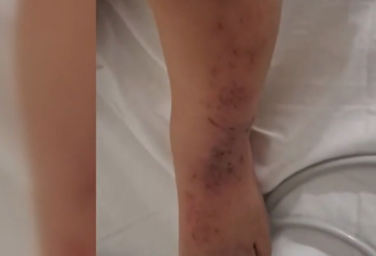 El nene sufrió varios raspones y hematomas. El nene sufrió varios raspones y hematomas.