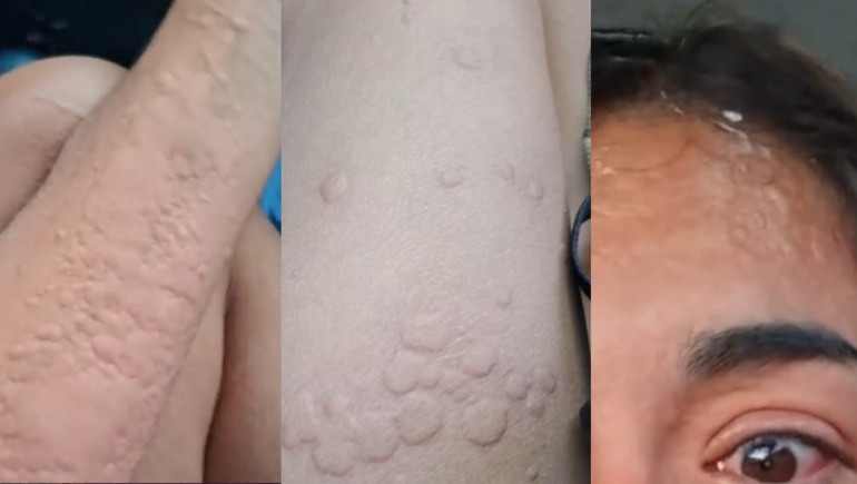 Una joven fue picada por una chaqueta amarilla y documentó toda la reacción que le provocó.