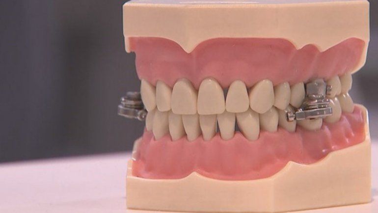 Viral: crean dispositivo para adelgazar cerrando los dientes con un candado.