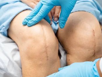 El tornillo utilizado para cirugías de rodilla fue prohibido por ANMAT por presentar irregularidades en su registro. El tornillo utilizado para cirugías de rodilla fue prohibido por ANMAT por presentar irregularidades en su registro.