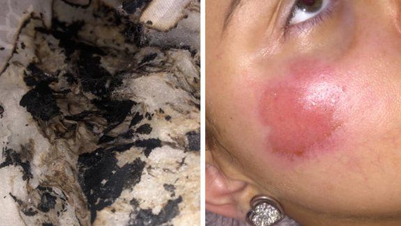 Facebook: explota cargador de iPhone y le quema la cara mientras dormía