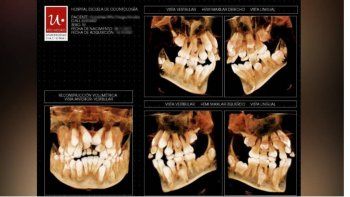 Niño cirugía dientes 02.jpg