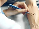 Argentina creó una vacuna contra el cáncer de piel más agresivo: cuándo estará disponible