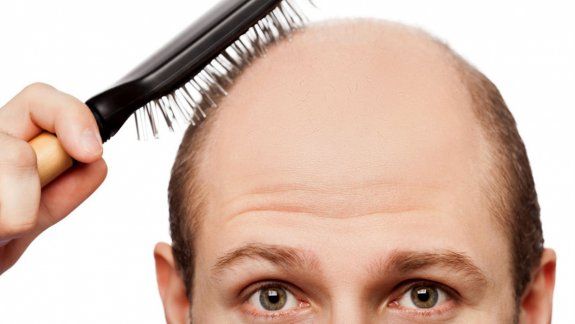 Los resultados de esta investigación inglesa servirán para encontrar una alternativa en la búsqueda de solucionar la pérdida de cabello severa.